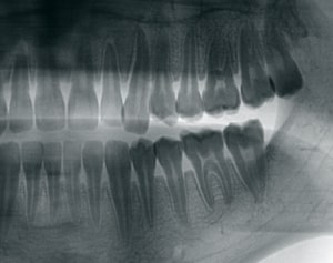 https://www.smilecharlotte.com/wp-content/uploads/2023/02/teeth-xray.jpg