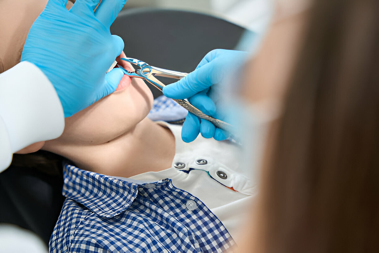 Tooth Extractions: What Every Patient in San Antonio, TX Needs to Know – Tips from Smile Charlotte_2