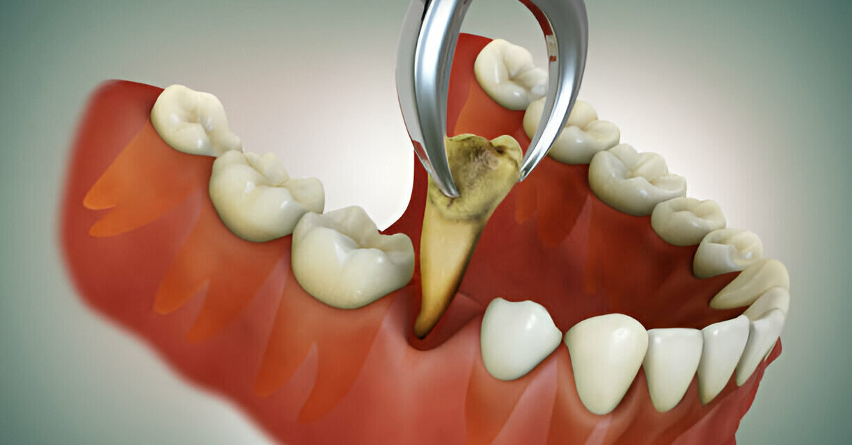 Tooth Extractions: What Every Patient in San Antonio, TX Needs to Know – Tips from Smile Charlotte