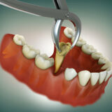 Tooth Extractions: What Every Patient in San Antonio, TX Needs to Know – Tips from Smile Charlotte_FI