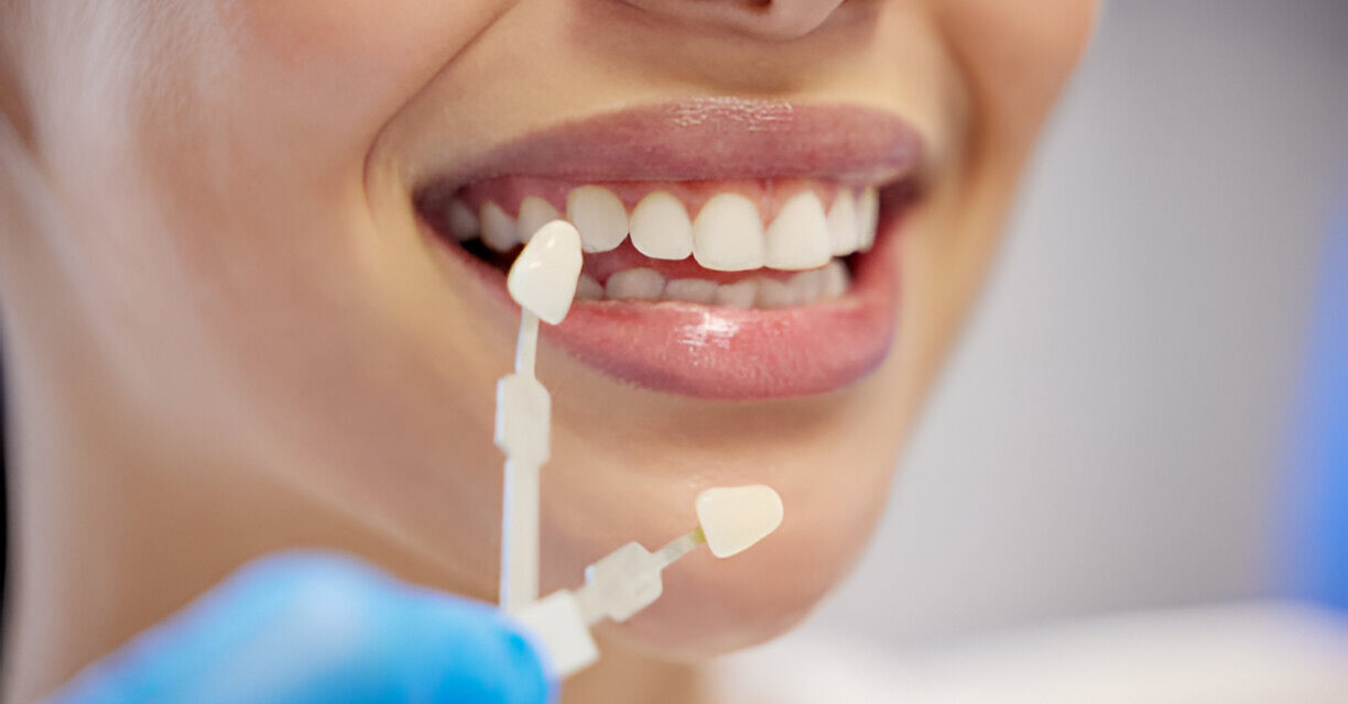 The Benefits of Same-Day Veneers for a Stunning Smile Transformation